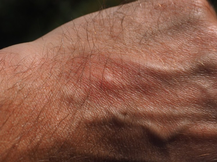 mosquito-bite-2117421_1920